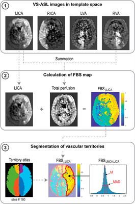 A Combined Computational Fluid Dynamics and Arterial Spin Labeling MRI Modeling Strategy to Quantify Patient-Specific Cerebral Hemodynamics in Cerebrovascular Occlusive Disease